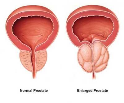 what is enlarged prostate size