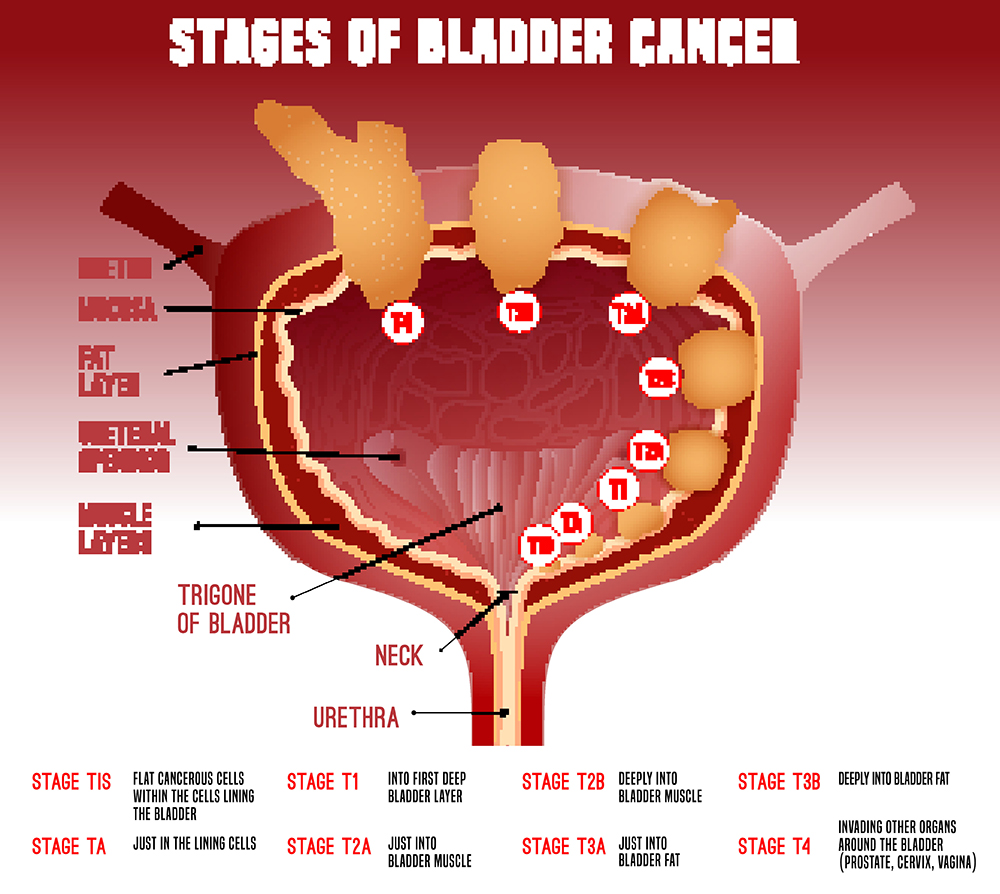 High Grade Superficial Bladder Cancer Treatment