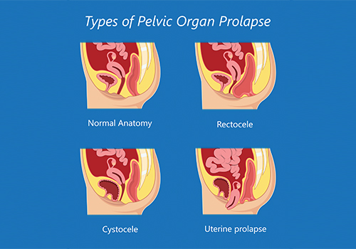What is Pelvic Organ Prolapse?  Types of Prolapse, Diagnosis