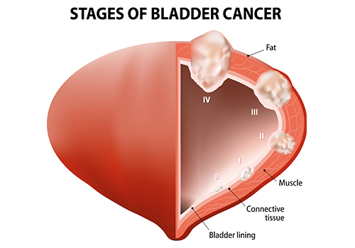 Bladder Cancer AAUrology