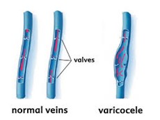 varicocele veins
